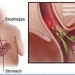 infant-reflux