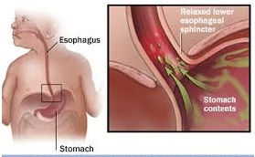 infant-reflux