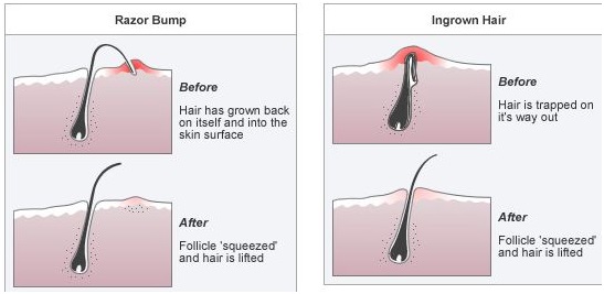 ingrown-hair