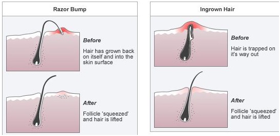What Causes Ingrown Hairs Ingrown Hairs Pseudofolliculitis TXXSRN What Causes Ingrown Hairs Ingrown Hairs Pseudofolliculitis TXXSRN