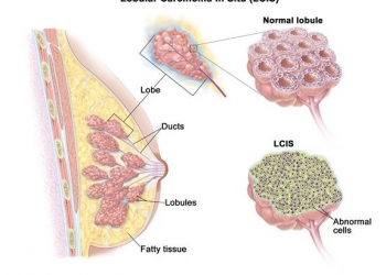lobular-carcinoma-in-situ