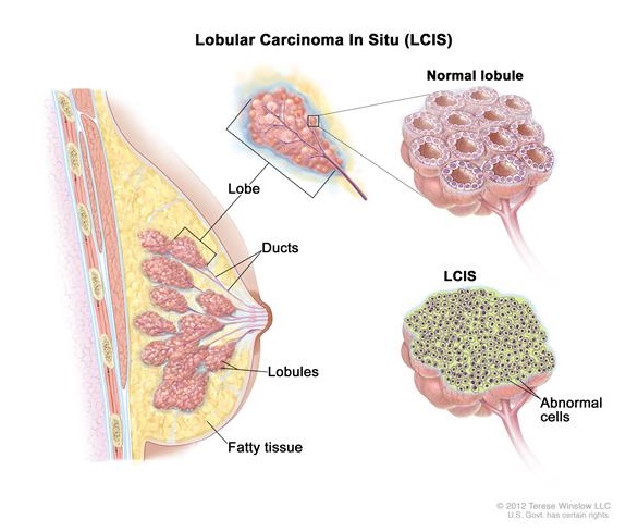 lobular-carcinoma-in-situ