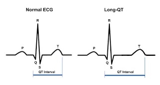 long-qt-syndrome