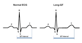 long-qt-syndrome