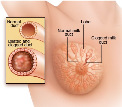 mammary-duct-ectasia