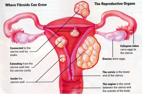 menorrhagia