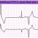 premature-ventricular-contractions