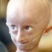 progeria