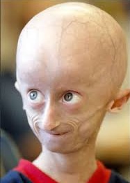 progeria