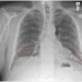 pulmonary-fibrosis