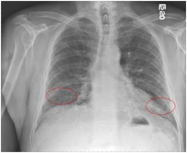 pulmonary-fibrosis