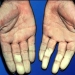 raynauds-disease