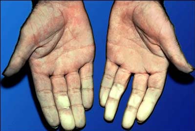 raynauds-disease