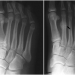 stress-fractures