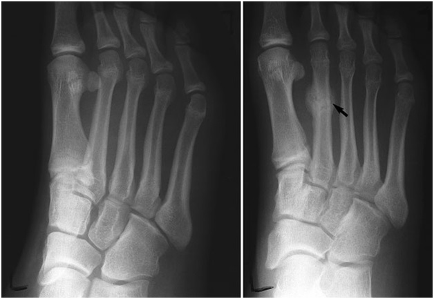 stress-fractures