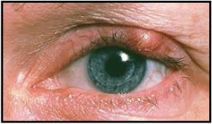 styes