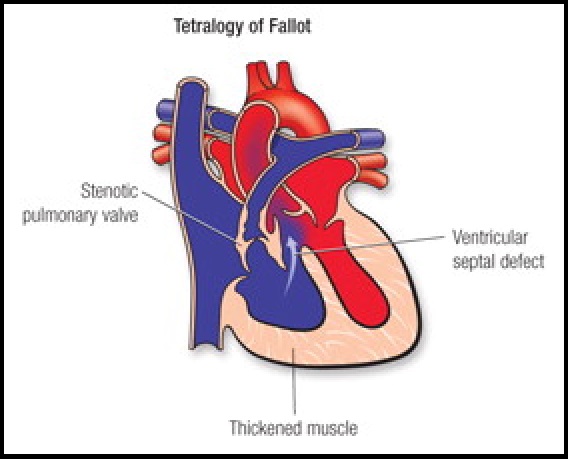 tetralogy-of-fallot