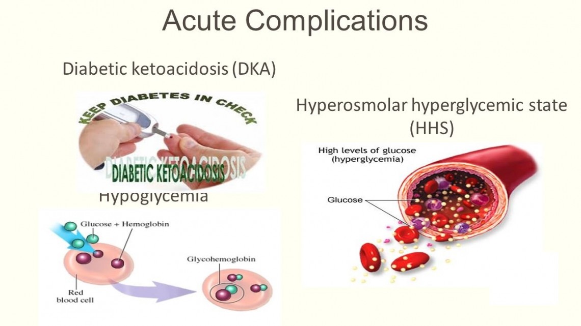 Diabetic Hyperosmolar Syndrome Causes, Symptoms, Diagnosis And