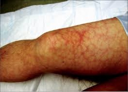 antiphospholipid-syndrome