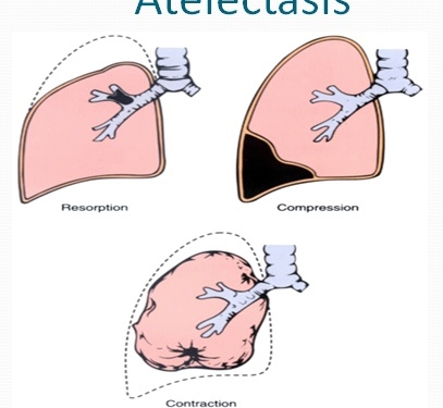 Atelectasis Causes Symptoms Diagnosis And Treatment Natural Health News