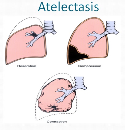 atelectasis