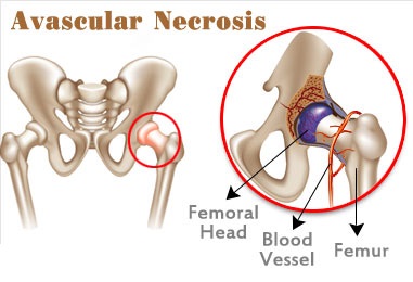 avascular-necrosis