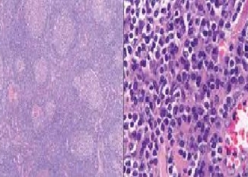 castleman-disease