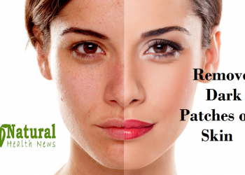 Dark Patches of Skin