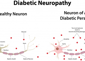 diabetic-neuropathy