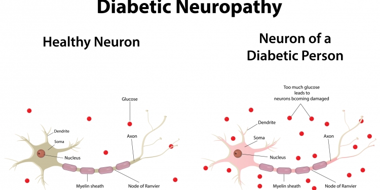 diabetic-neuropathy