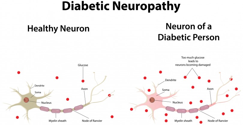 Diabetic Neuropathy Causes, Symptoms, Diagnosis And Treatment - Natural