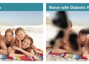 diabetic-retinopathy