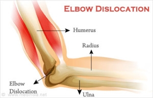 elbow-dislocation
