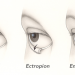 entropion