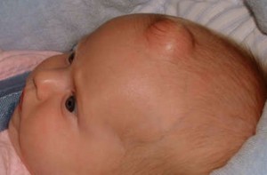 Epidermoid Cysts Causes, Symptoms, Diagnosis and Treatment - Natural ...