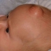 epidermoid-cysts