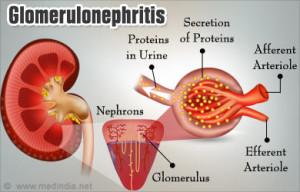 glomerulonephritis