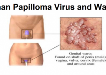 HPV Infection