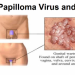 HPV Infection