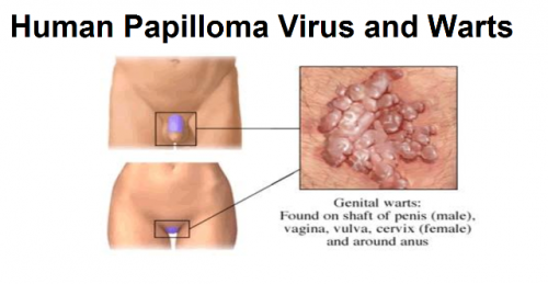 HPV Infection