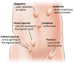 Inguinal Hernias