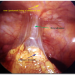 Abdominal Adhesions
