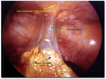 Abdominal Adhesions