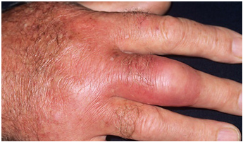 Cellulitis