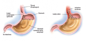 Dyspepsia
