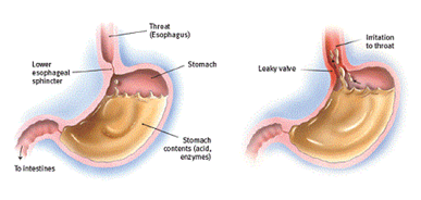 Dyspepsia