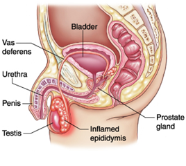 Epididymitis