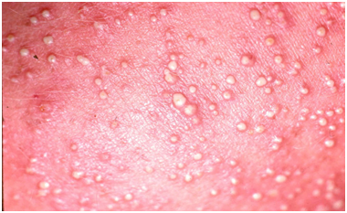treatment for prickly heat