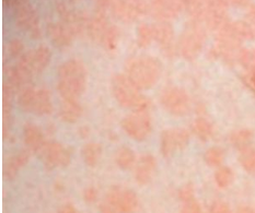 Epididymitis Causes, Symptoms, Diagnosis and Treatment - Natural Health