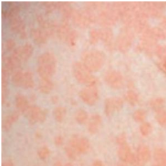 Tinea Versicolor